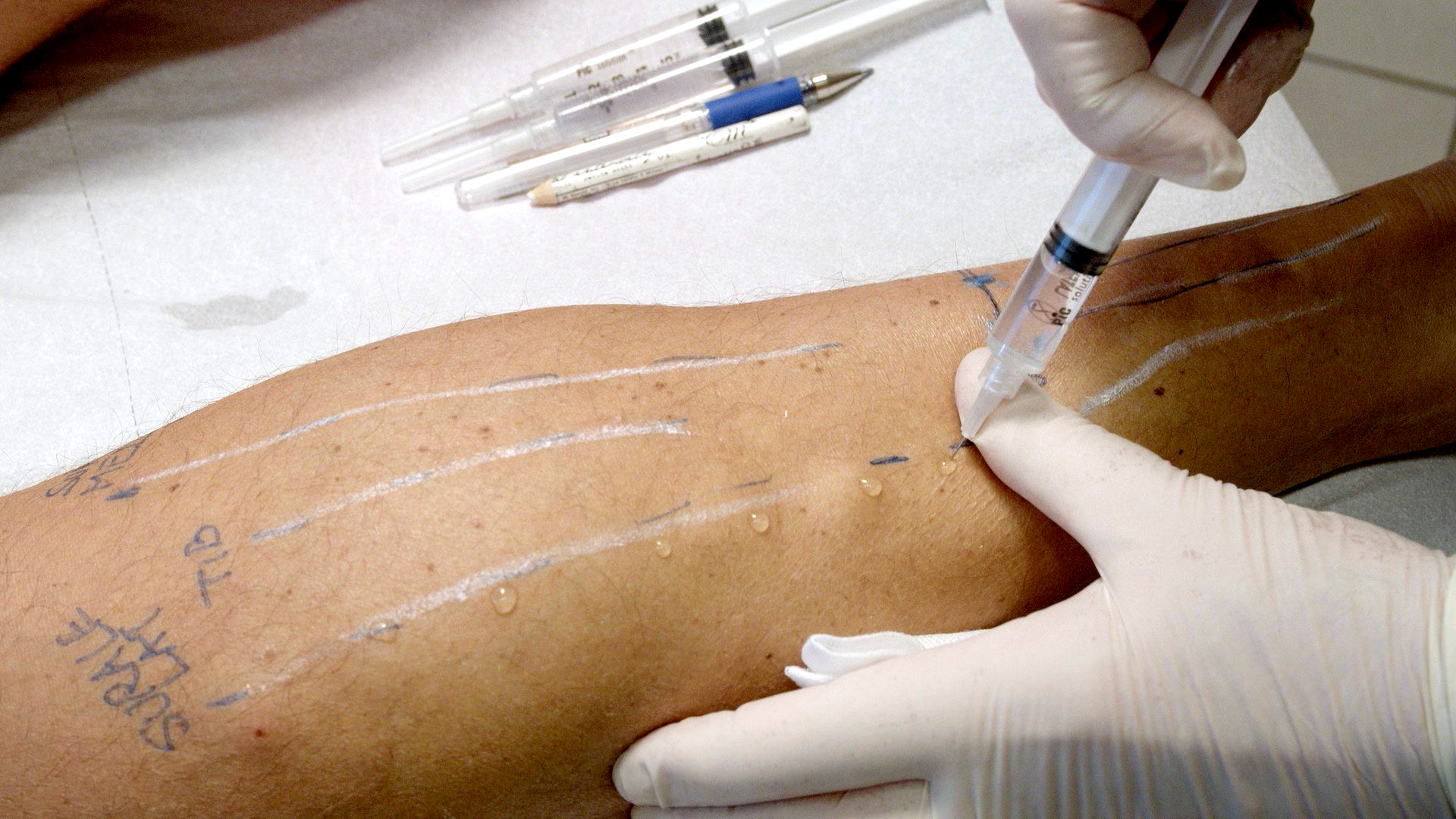 proloterapia-03-cavallino-stephen-postural-project